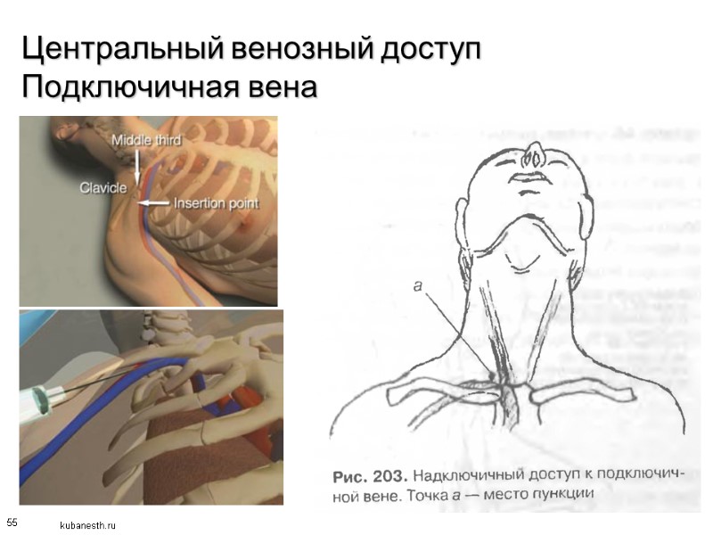 55 Центральный венозный доступ Подключичная вена